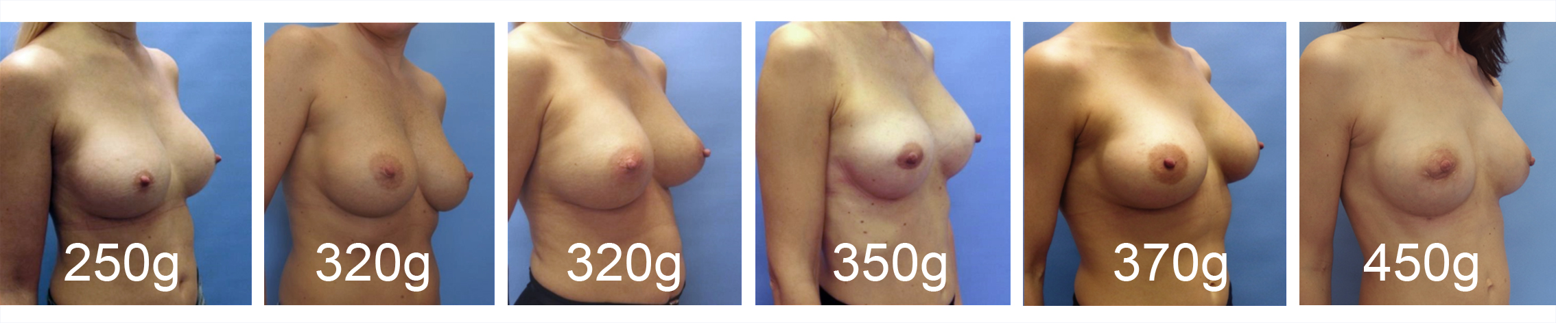 velikosti prsních implantátů